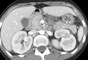 Sinclair, Shemeka, pancreatitis simul L renal mass-CT-5